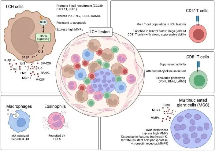 Langerhans cell histiocytosis LCH lesion composition.